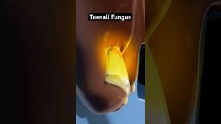 Eliminating persistent toenail fungus (3D Animation)