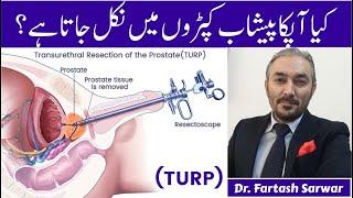 Transurethral resection of the prostate (TURP) | Procedure By Dr. Fartash Sarwar | Urdu/Hindi