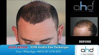 Hair Transplant Repair 2016 - Fixing Bad Hair Transplants Dr. Hakan DOGANAY