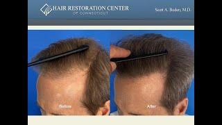 Restoring  A Hairline in 1 Hair Transplant Procedure.