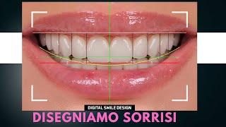 Metodo di applicazione delle faccette dentali - Studio Cannizzo Milano