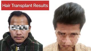 Hair Transplant Results 7 months timeline |