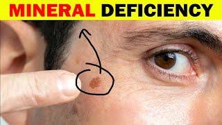 #1 Mineral To Remove Age Spots In People Over 50