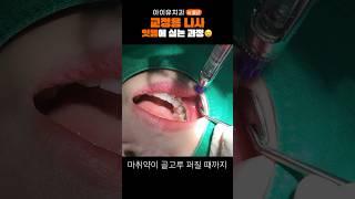 교정 스크류? 잇몸에 나사를 심어요? #shrots