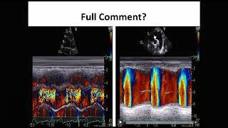 Traces-2  Role of Color M-mode in Assessment of AR severity