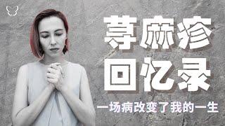 荨麻疹回忆录 | 一场病改变了我的一生 | Urticaria Change My Life