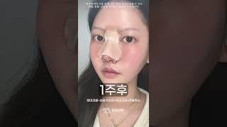슈가성형외과 코성형 성형전~3달차까지 변화