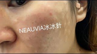 【Neauvia冰冰針】又炒冷飯｜公開打完針的LOGO臉及珍貴影片｜到底咩人先啱？