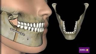 Mandibular Advancement for aesthetic beauty