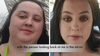 Biggest struggles after bariatric surgery. Weight Loss Latvia patient stories.