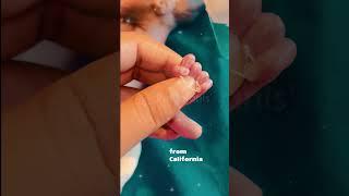 Baby weighing 300gms  | Smallest Baby in the world #baby #prematurebaby #newbornbaby