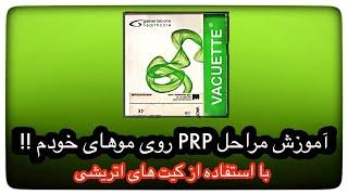 آموزش مراحل PRP روی مو های خودم