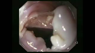 Endoscopic division of a Zenker diverticulum using the Clutch Cutter