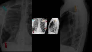 Emphysema #meded #copd #pulmonology #tobacco #medicaleducation