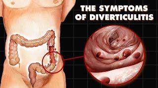 Understanding Diverticulitis-Doctor Explains