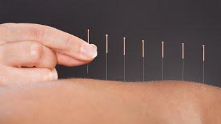 The Science Behind How Acupuncture Helps Relieve Pain: A Doctor Of Chinese Medicine Explains