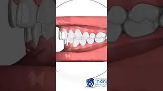 Aligners Treatment Plan|3D Simulation | See Results before we start the Treatment | Invisalign Steps