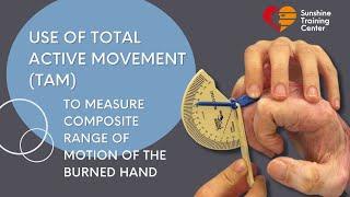 Using Total Active Motion to measure composite ROM of the burned hand