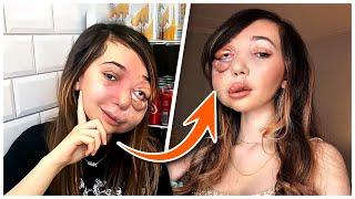 The Curse of Nikki Lilly: A Rare Blood Disease That Deformed Her Face!