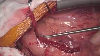 Off-Pump Coronary Artery Bypass Grafting: RA to LIMA 'T' Graft