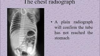 Dr. Mohamed Shehata, Trachea-esophageal fistula for undergraduate, Tanta university, Egypt