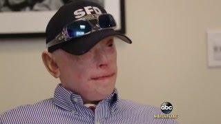 Severely-Burned Former Firefighter Opts for Face Transplant: Part 1 | ABC News