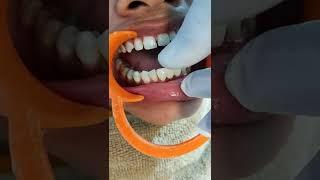 #waidhan#singrauli#dental#दांत#capping" missing teeth replacement done in rk dental skin hair clinic