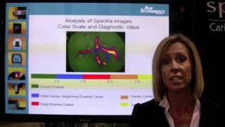 Anastasia Turchetta, RDH, discusses the Spectra caries detection system