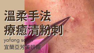 溫柔手法療癒清粉刺-Taiwan Yilan 宜蘭清粉刺達人yafang 亞芳老師(莊雅芳老師)