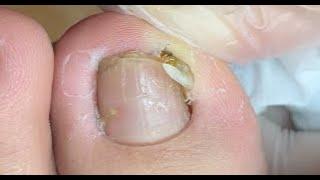 Removal of sickle-like toenails