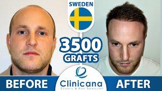 Mr. Poka from Sweden had his Hair Transplant Surgery at Clinicana Istanbul, Turkey