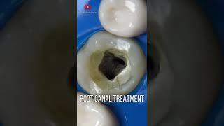 Endodontics or Root Canal Treatment in 4K