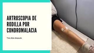 Artroscopia de rodilla por condromalacia en paciente joven