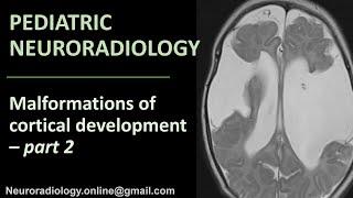 Pediatric Neuroradiology - Malformations of Cortical Development (part 2)