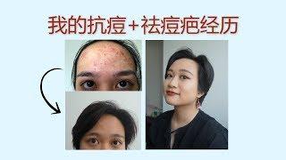 -敦儿Cecilia-Acne Experience从痘肌到不易长痘肌，五年抗痘祛痘疤经历，护肤干货