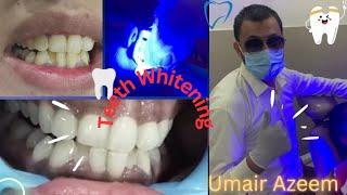 Brightening smile with bleaching.All steps #dental#youtube#umair toothfairy@Umairazeem8553