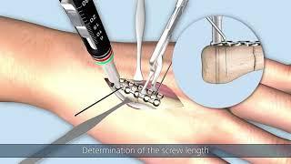 Transverse fracture of  4th metacarpal| 4th metacarpal fracture #3danimation  #animation