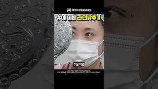 쌍꺼풀 라인낮추기 수술 2달 후기 #shorts