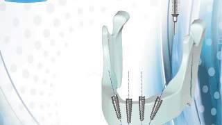 Cortex Dental Implants: Clever Click Connection