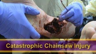 Catastrophic Chainsaw Accident (Viewer Discretion Advised)