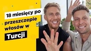 Przeszczep włosów Turcja 18 miesięcy później