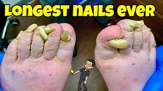 SUPER LONG TOENAILS CUTTING | AMAZING TRANSFORMATION