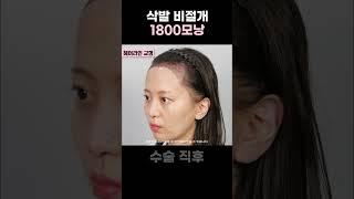 헤어라인교정 삭발비절개 1800모낭｜모발이식｜헤어라인교정｜두피문신｜다나성형외과