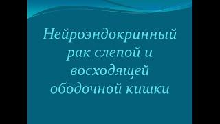 Нейроэндокринный рак слепой и восходящей  ободочной кишки