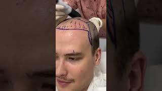 Hair Transplant in Turkey | Hair Transplant Process  #hairtransplantturkey