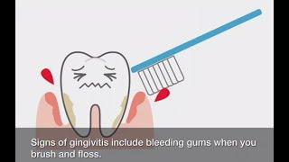 Gum Disease Stage 1: Gingivitis