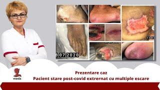 Prezentare caz - Pacient stare post-covid extrernat cu multiple escare - Promo #medatalos #nursery