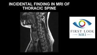 Incidental finding in MRI of thoracic spine