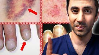 Doctor Explains 11 Skin Signs of Liver Disease / Fatty Liver / Cirrhosis