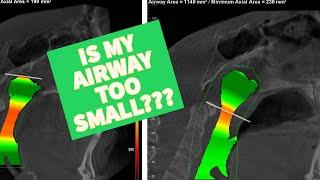 IS MY AIRWAY TOO SMALL?